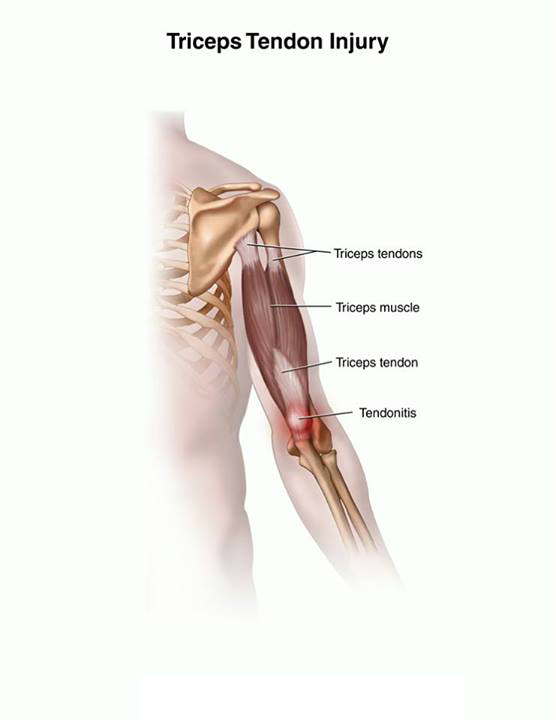 Тендинит трицепса фото