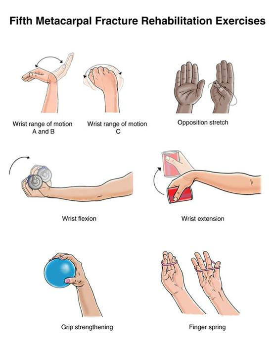 Hand Fracture Fifth Metacarpal (Boxer's) Fracture - PhysioDiary