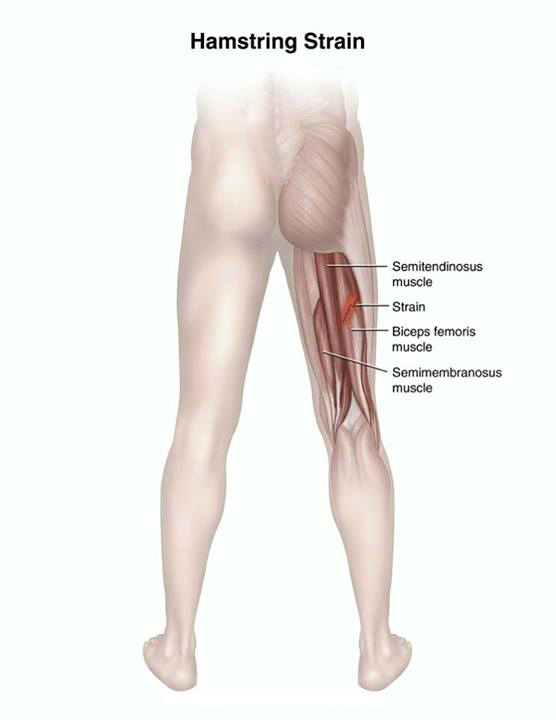 Hamstring Strain PhysioDiary