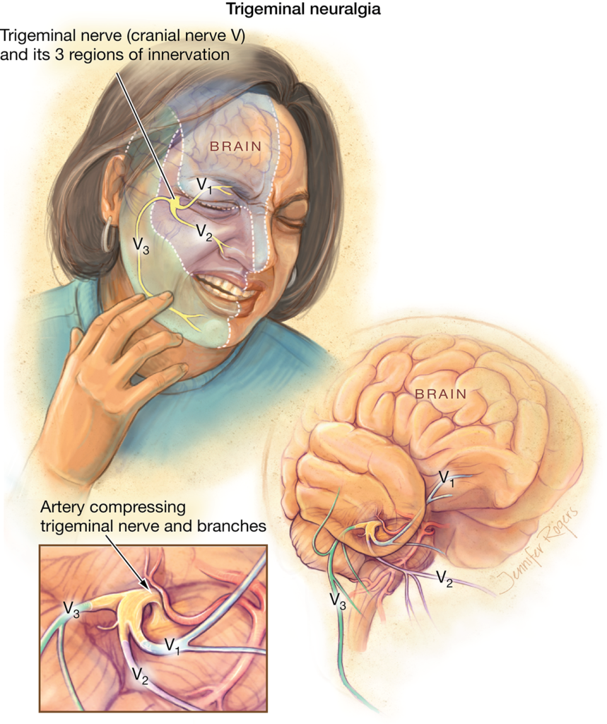 Trigeminal Neuralgia - PhysioDiary